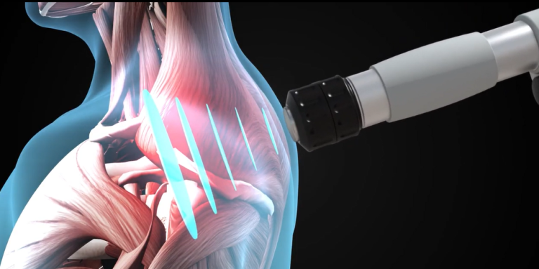 Extracorporeal Shockwave Therapy (ESWT) and Radial Shockwave Therapy (RSWT) in Physiotherapy